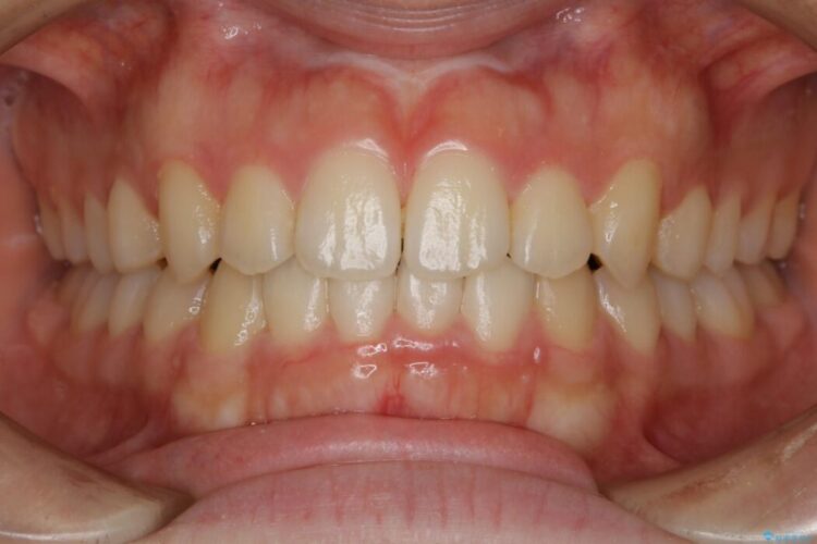 【10代女性】すきっ歯（正中離開）のインビザライン治療 治療後画像