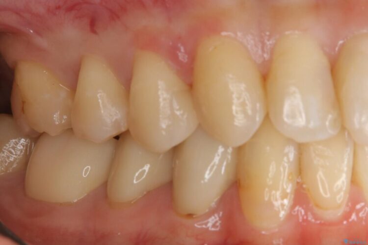 【20代 女性】劣化した保険のプラスチックをセラミックへ 治療後画像