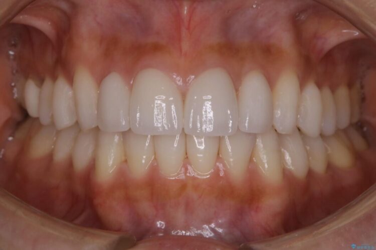 【30代女性】噛み合わせのズレを解消する 治療後画像