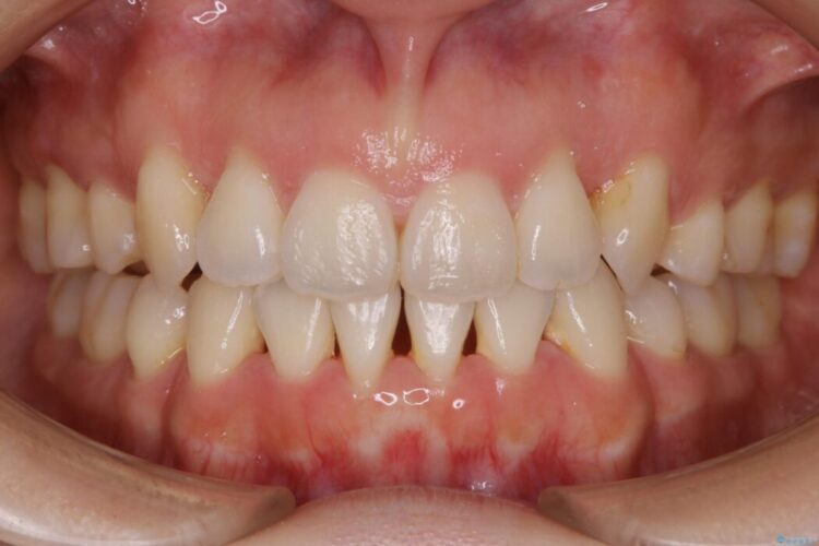 【30代女性】インビザラインで抜歯矯正 治療後画像