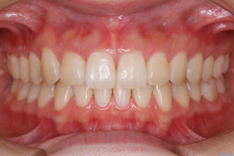 【20代女性】噛み合わせのズレからくるガタついた歯列をインビザライン矯正治療 治療後画像