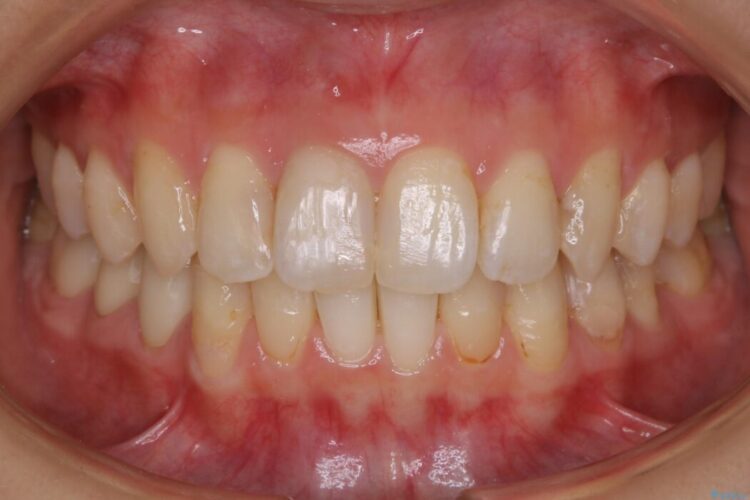 【20代女性】非抜歯で歯列をコンパクトに 治療後画像