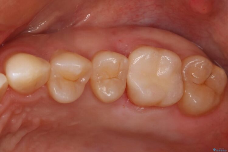 【30代女性】黒ずんだ虫歯をセラミック治療 治療後画像