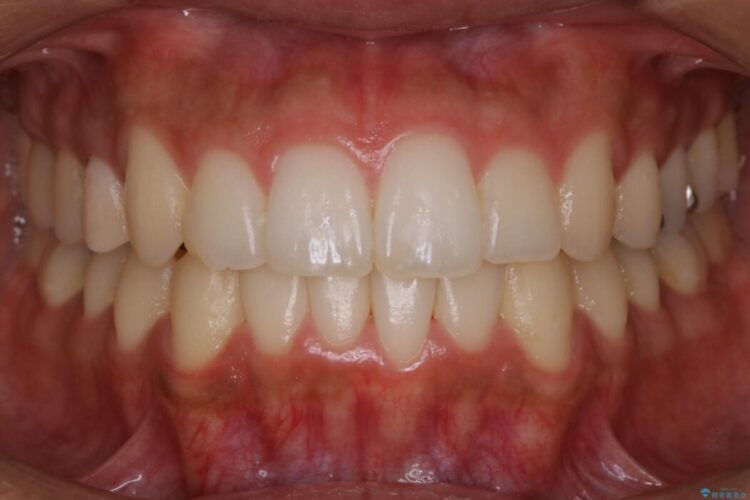 【20代男性】出っ歯をインビザラインで矯正治療 治療後画像