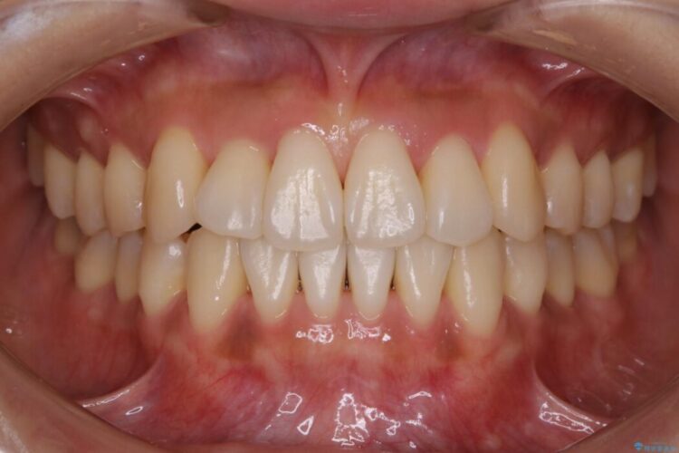 【20代女性】抜歯無しで前歯のがたがたを改善する 治療後画像