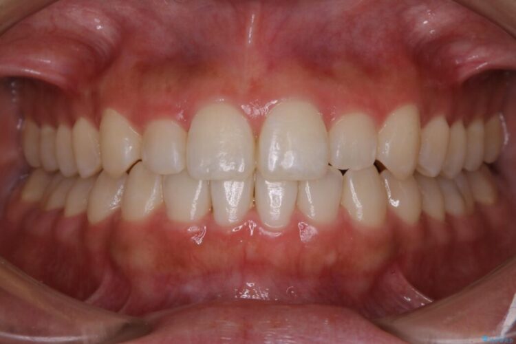 【20代女性】軽度の反対咬合を部分矯正でなおす 治療後画像