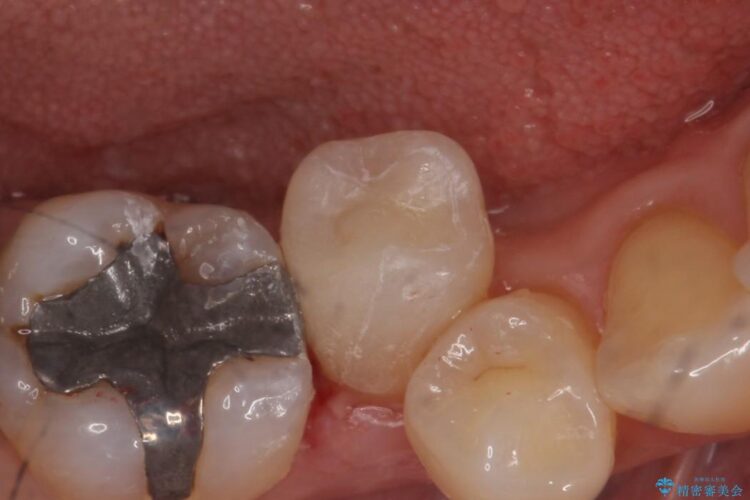 【50代女性】銀歯を見た目のきれいなセラミックに 治療後画像