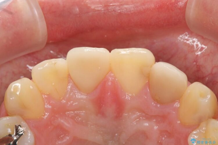 【30代男性】神経一歩手前の深い虫歯をセラミッククラウンで治療 治療後画像