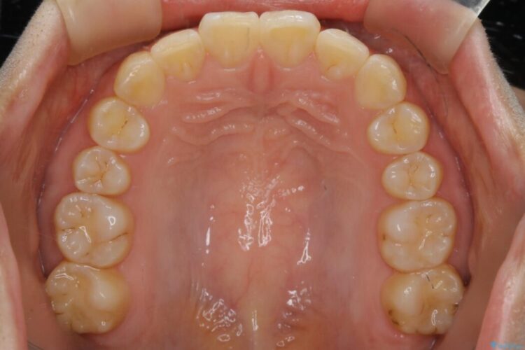 【30代女性】歯を長持ちさせるための咬合調整 治療後画像