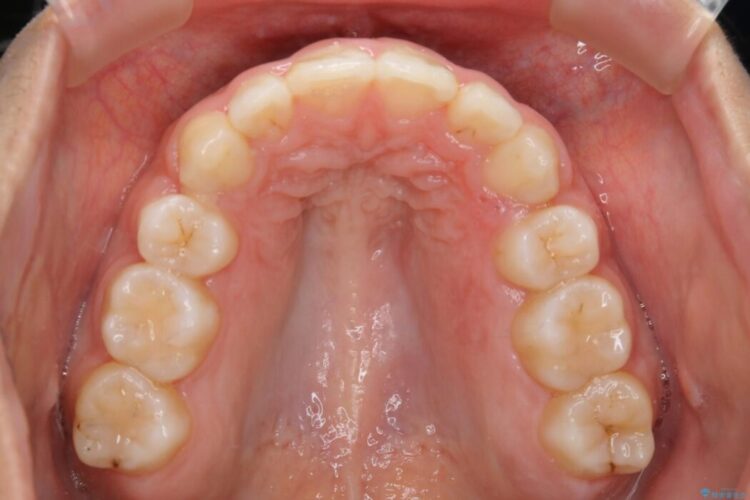 【20代女性】口元を引っ込めたい Eラインの改善 治療後画像