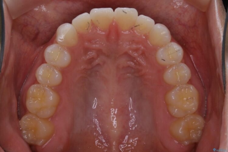 【20代女性】短期間でのインビザライン治療で見た目の悩みを改善する 治療後画像