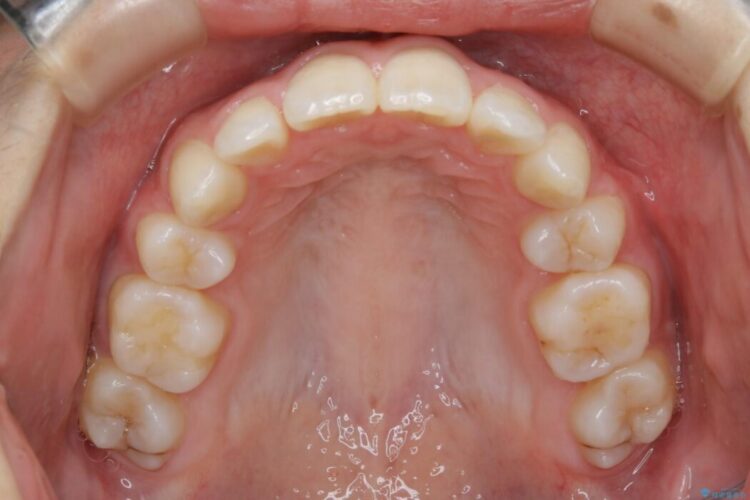 【20代女性】抜歯矯正で出っ張った口元を改善する 治療後画像