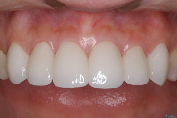 【30代女性】前歯の見た目をセラミッククラウンで変える 治療後画像