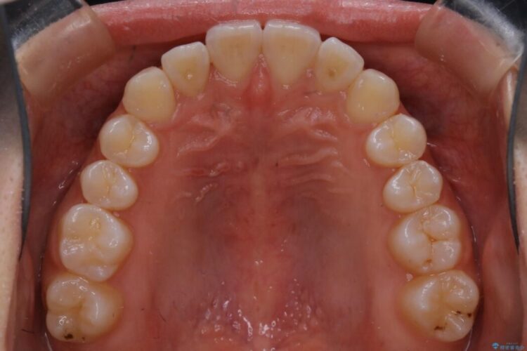 【10代女性】早めに始める受け口（反対咬合）の矯正治療 治療後画像