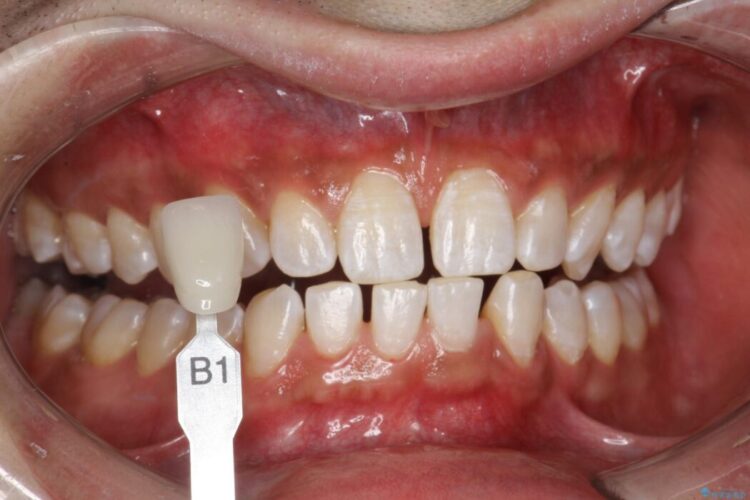 【30代男性】ホワイトニングでできる限り白くしたい 治療後画像