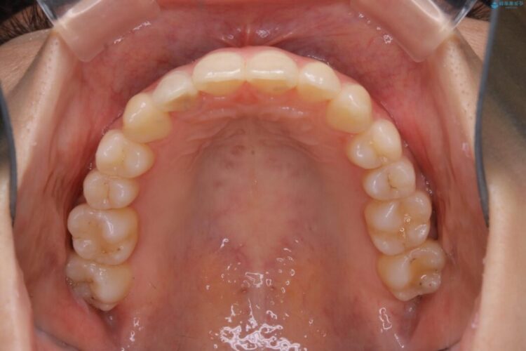 【20代女性】非抜歯でもガタガタを改善するインビザライン矯正 治療後画像