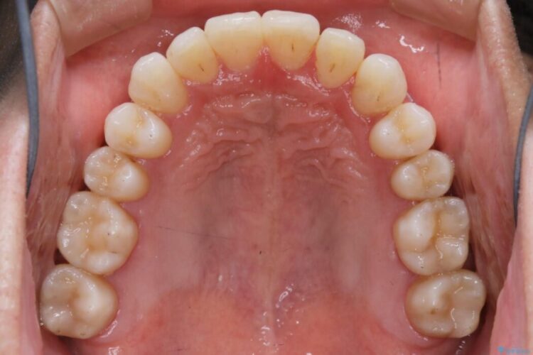 【20代男性】上顎のガタガタな歯列をインビザラインで矯正治療 治療後画像