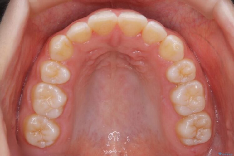 【20代女性】前歯が噛み合わない!開咬（オープンバイト）の矯正治療 治療後画像