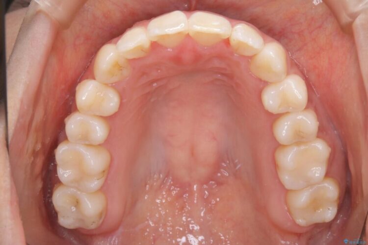 【20代女性】隠れた前歯とガタつきをきれいな歯列弓へ 治療後画像