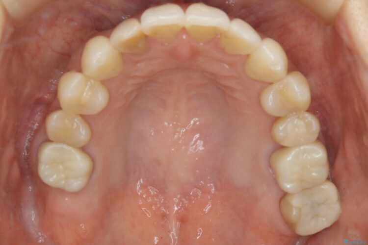 【30代女性】前歯の反対咬合をマウスピースで改善 治療後画像