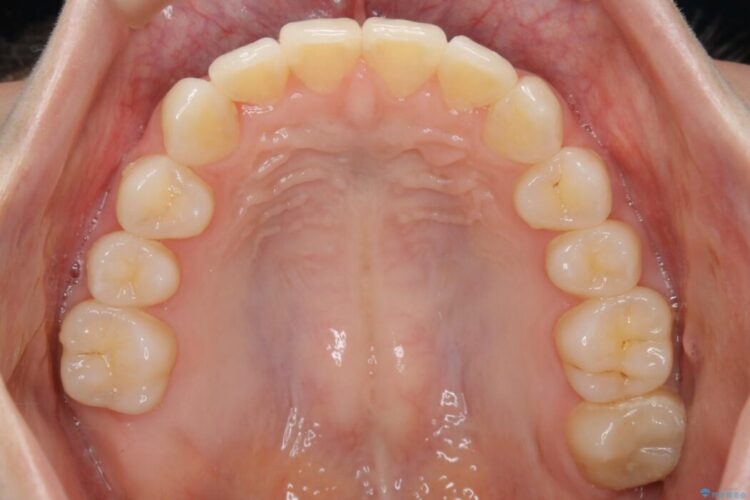 【20代女性】ブライダルに向けた矯正できれいなスマイルラインへ 治療後画像