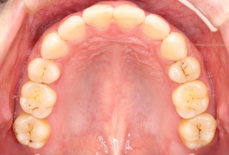 【20代女性】出っ歯の矯正 治療例 治療後画像