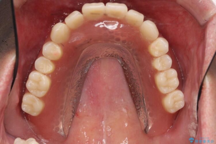 【50代男性】重度の歯周病をインプラントを用いた上顎義歯（入れ歯）で補綴治療 治療後画像