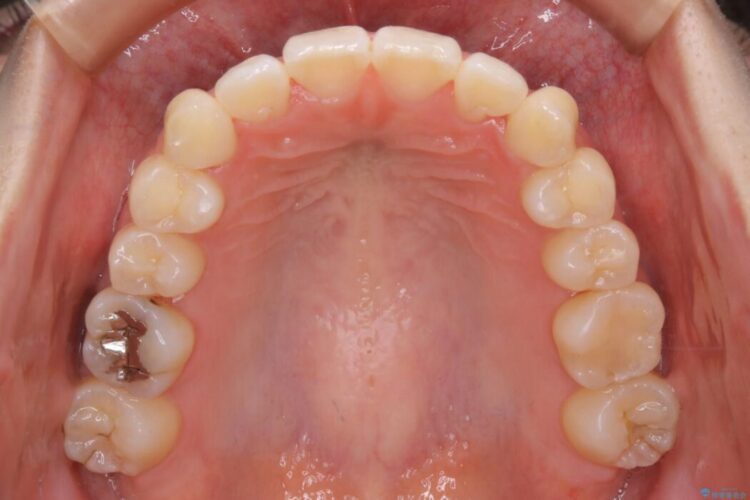 【20代女性】前歯の真ん中（正中）のズレとガタつきを効率よく矯正する 治療後画像