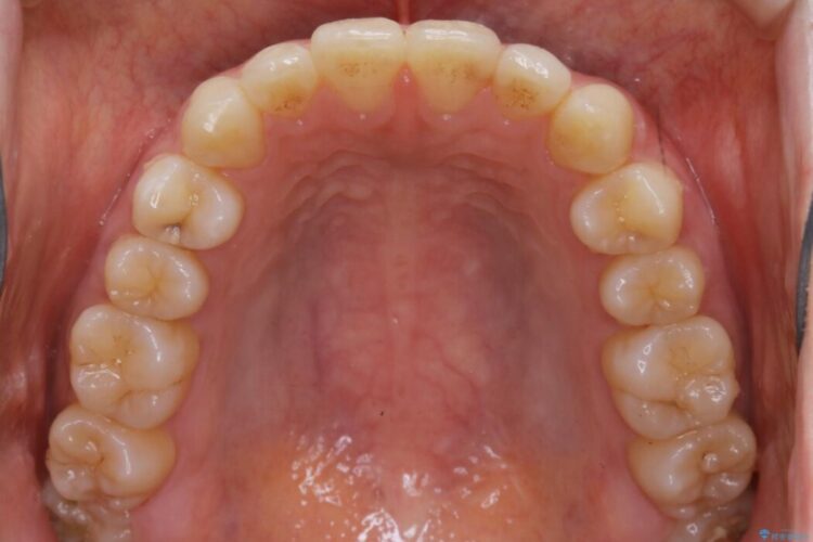 【20代 女性】インビザラインで短期間矯正 治療後画像