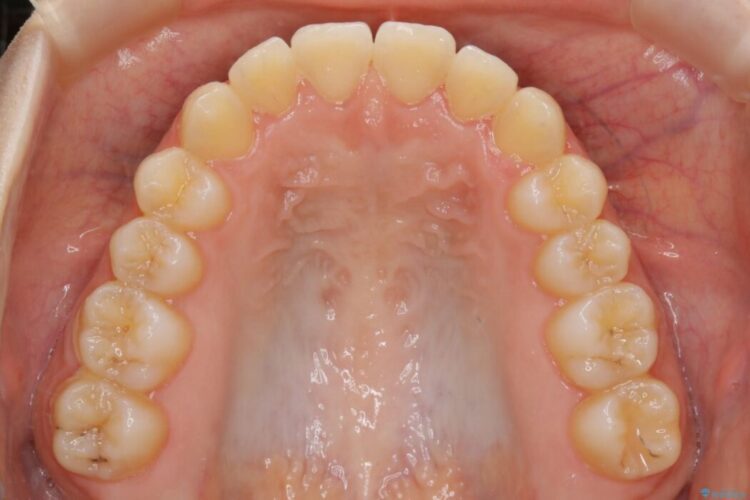 【10代女性】すきっ歯（正中離開）のインビザライン治療 治療後画像