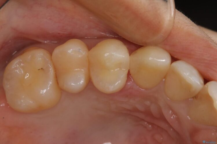 【20代 女性】劣化した保険のプラスチックをセラミックへ 治療後画像