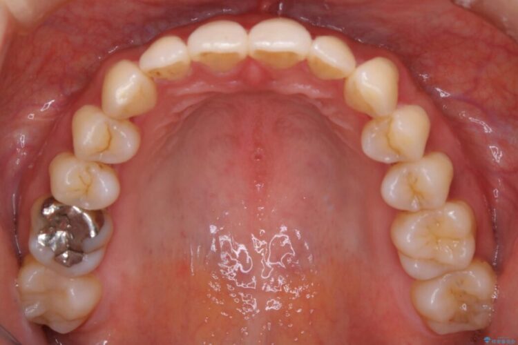 【30代女性】非抜歯で噛み合わせとガタつきの改善 治療後画像