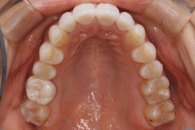 【30代女性】噛み合わせのズレを解消する 治療後画像