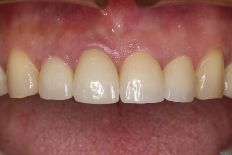 【50代男性】前歯の被せ物を新しく 治療後画像
