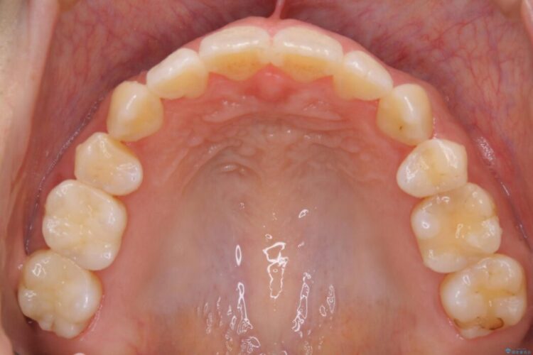 【30代女性】インビザラインで抜歯矯正 治療後画像