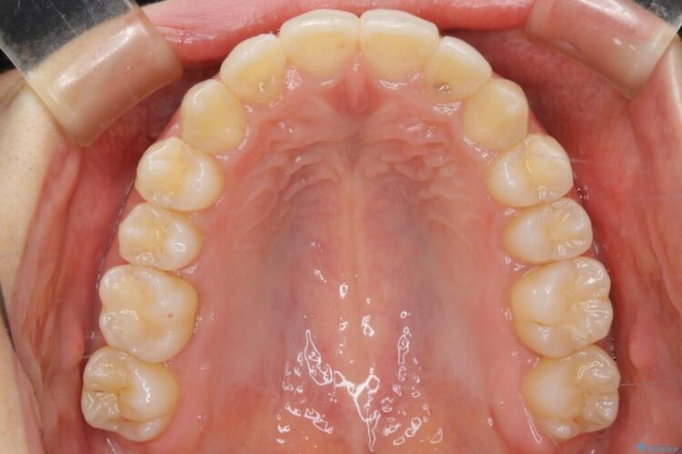 【20代女性】噛み合わせの歪みを超短期間でインビザライン治療 治療後画像