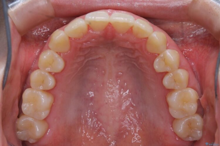 【20代女性】噛み合わせのズレからくるガタついた歯列をインビザライン矯正治療 治療後画像