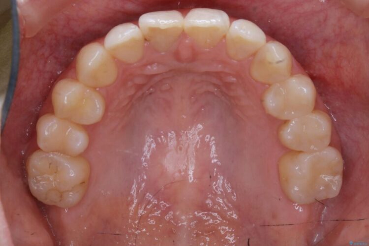 【20代女性】非抜歯で歯列をコンパクトに 治療後画像
