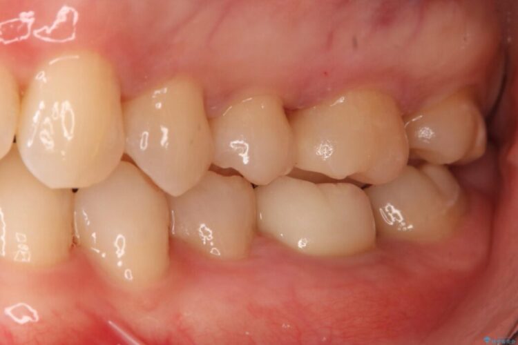 【30代女性】黒ずんだ虫歯をセラミック治療 治療後画像