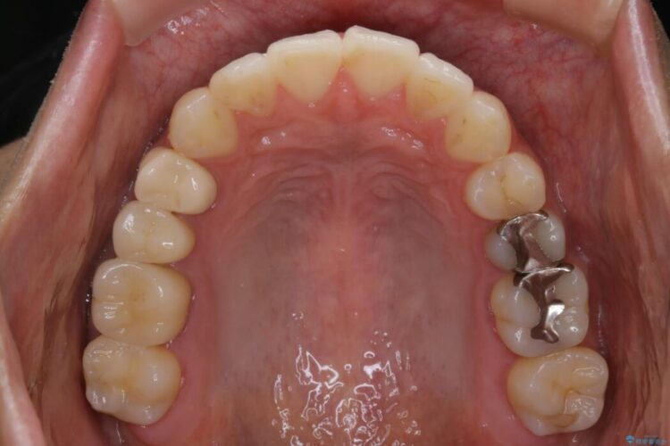 【20代男性】出っ歯をインビザラインで矯正治療 治療後画像