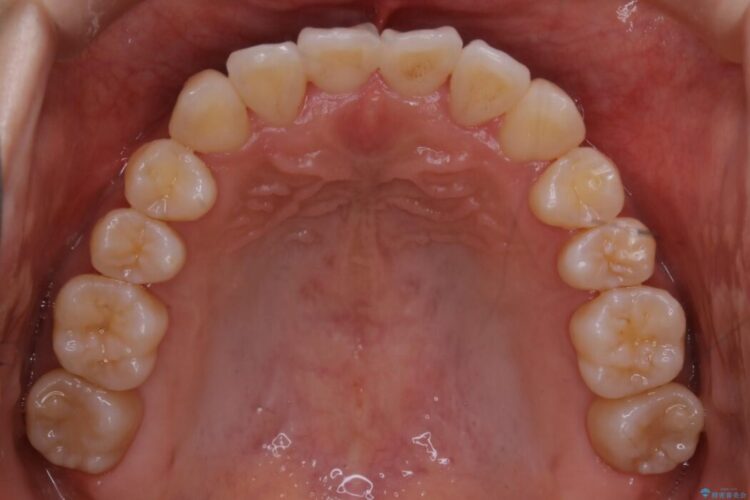 【20代女性】抜歯無しで前歯のがたがたを改善する 治療後画像