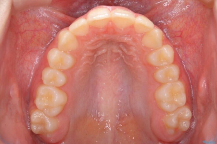 【10代女性】歯並びを整えて自信が持てる素敵な笑顔に 治療後画像