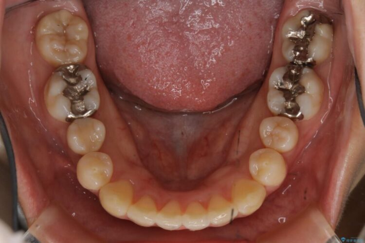 【20代女性】非抜歯でマウスピースの限界に挑戦する矯正治療 治療後画像