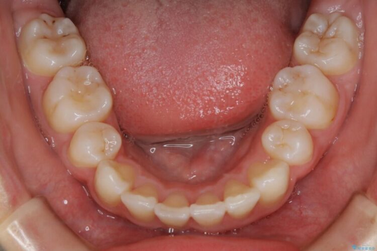 【20代女性】抜歯矯正で出っ張った口元を改善する 治療後画像