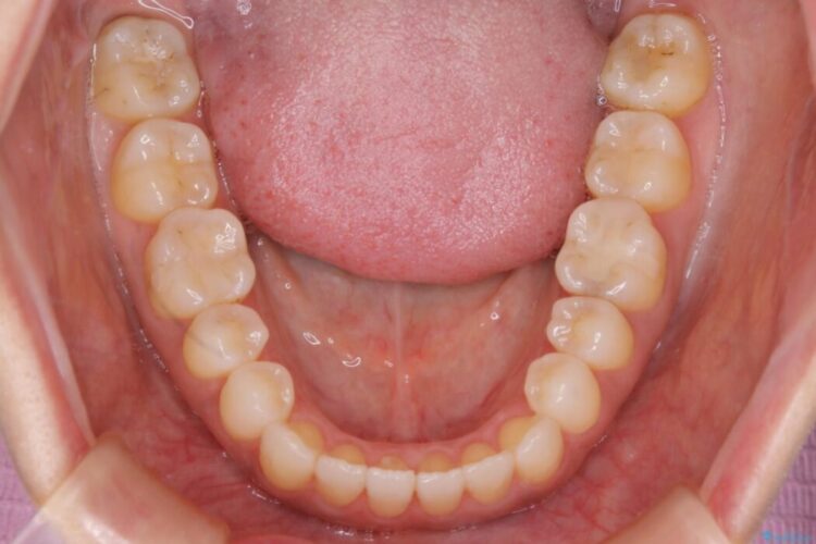 【30代女性】短期間で非抜歯による反対咬合(受け口)の改善 治療後画像