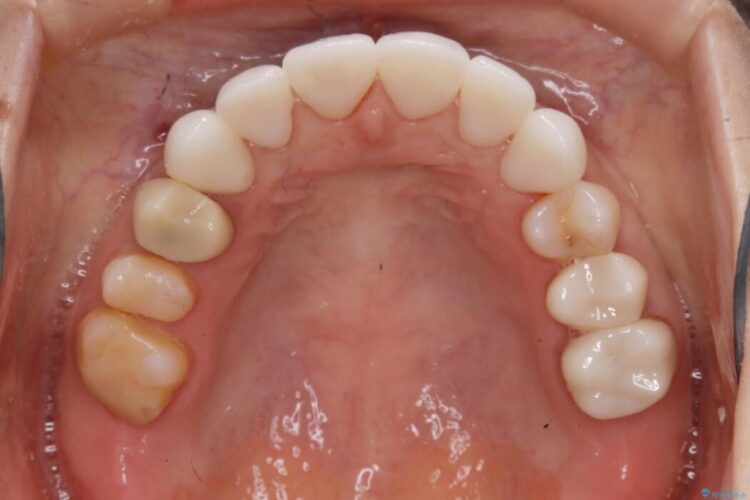 【30代女性】前歯の見た目をセラミッククラウンで変える 治療後画像