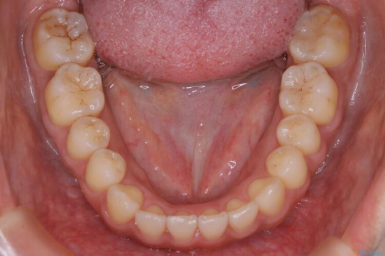 【20代女性】開咬の隙間と歯列の凸凹をまとめて改善する 治療後画像