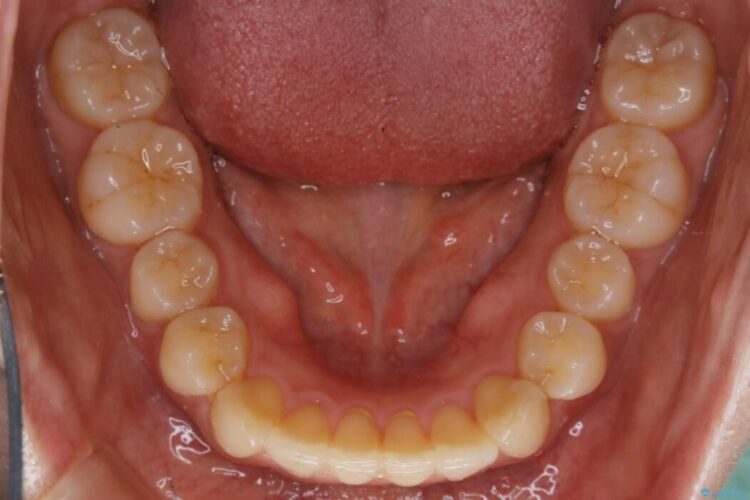 【20代女性】気になる部分だけをマウスピース矯正 治療後画像