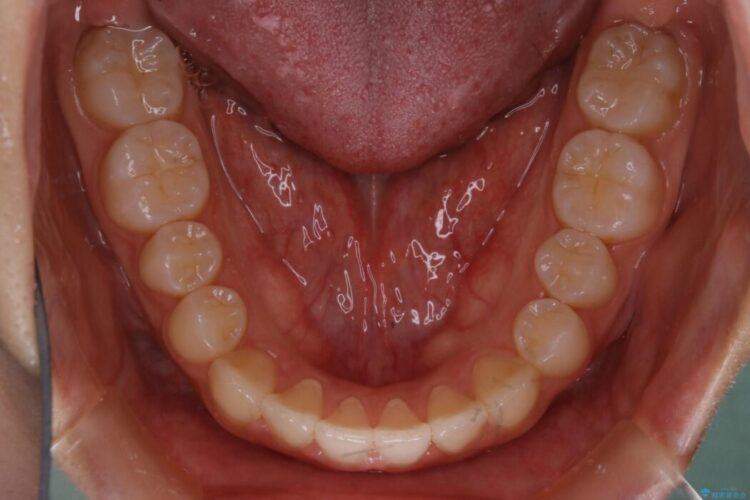 【10代女性】早めに始める受け口（反対咬合）の矯正治療 治療後画像