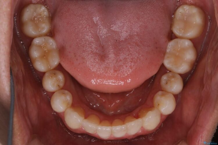 【20代男性】上顎のガタガタな歯列をインビザラインで矯正治療 治療後画像